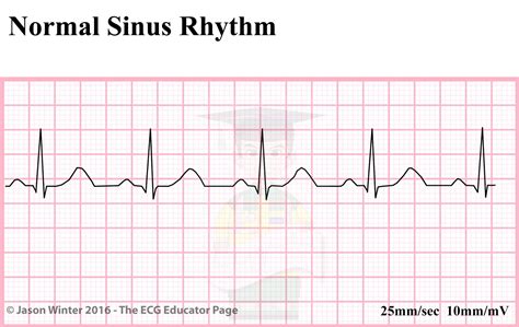 ecg nsr means